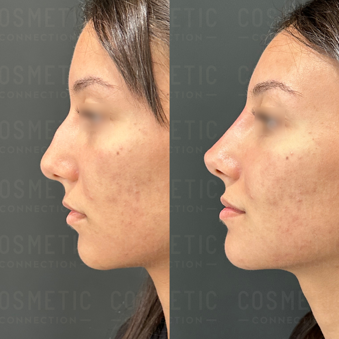 Side-by-side comparison of a womans profile before and after a cosmetic procedure. The left image shows her natural nose, and the right image displays a more refined nose shape. Complexion and facial features are otherwise consistent.