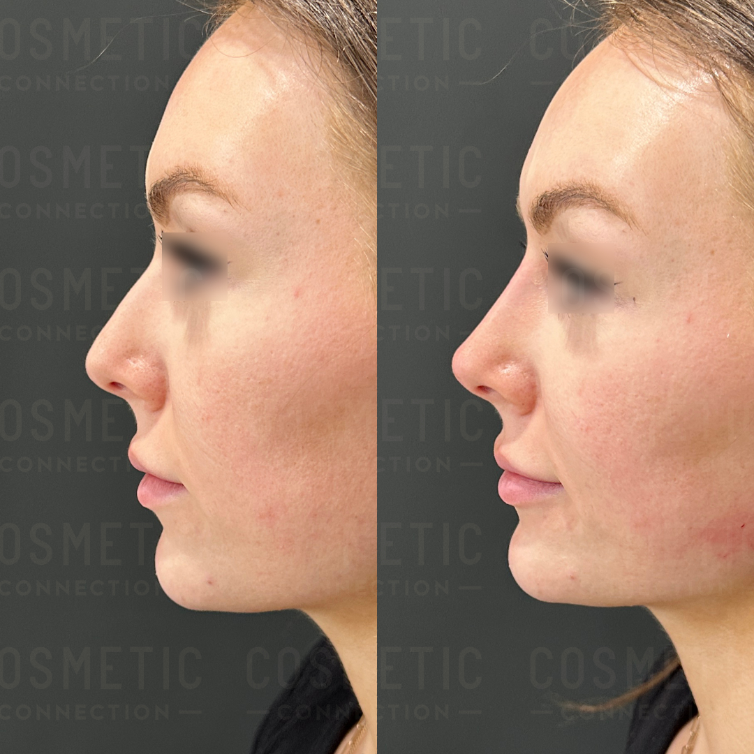 Side-by-side profile images of a womans face before and after cosmetic enhancement. The before image shows her original nose shape, while the after image displays a more refined nose contour.