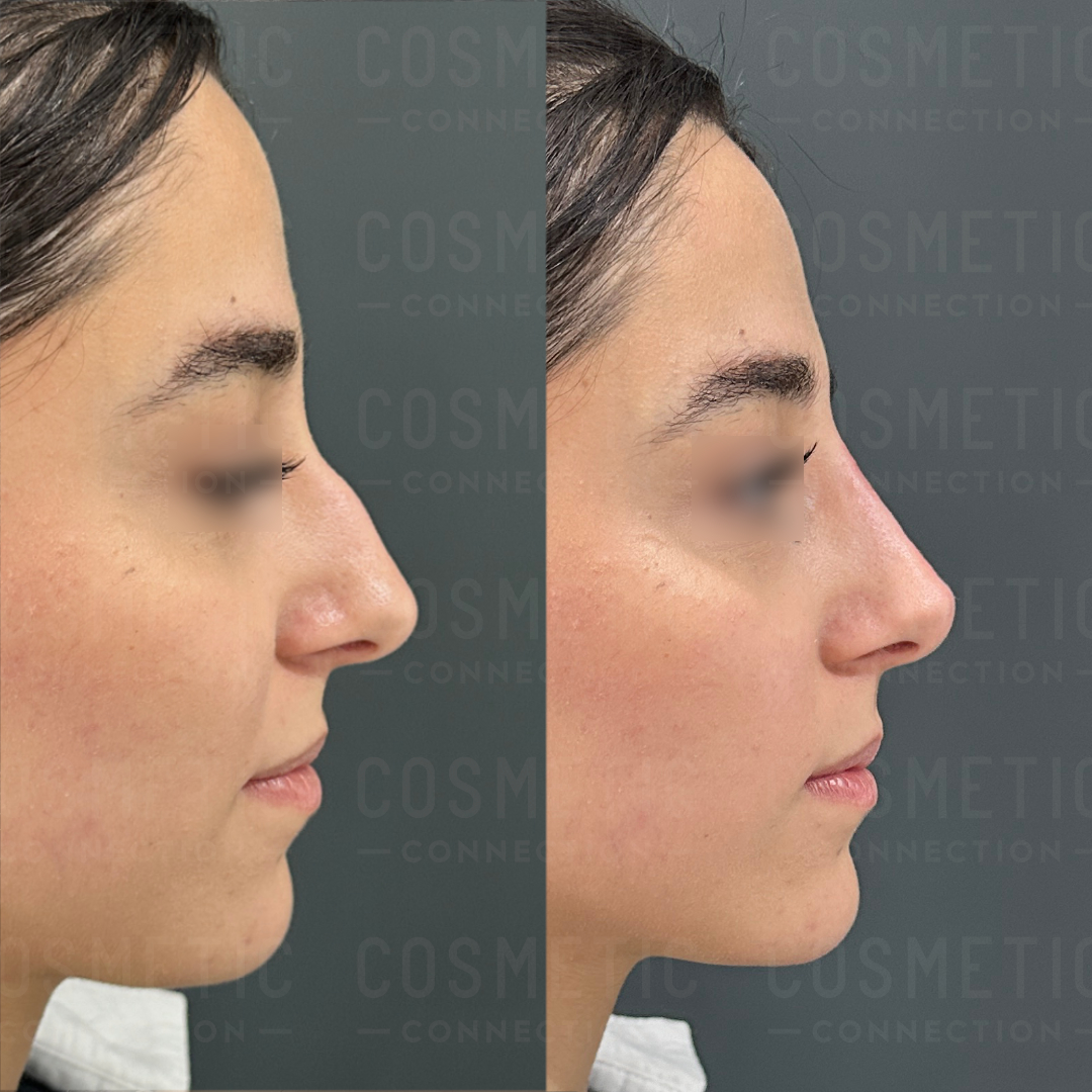 Side-by-side images of a persons profile before and after a non-surgical rhinoplasty. The left image shows a less defined nose shape, while the right image displays a more contoured nose shape. Hair is pulled back, and the background is gray.