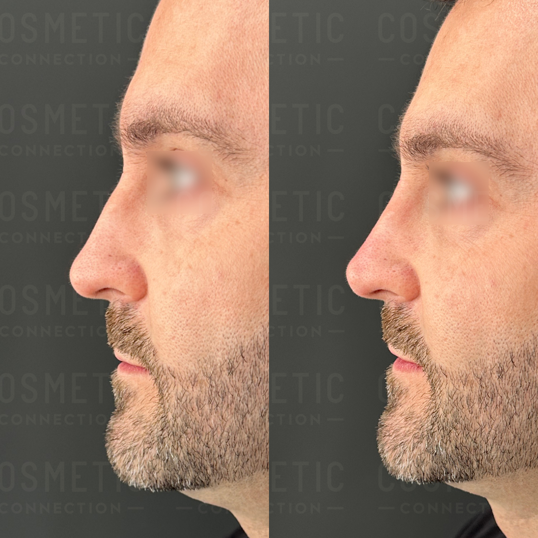 Side-by-side comparison of a mans profile shows before and after images of cosmetic facial enhancement. The left image displays a slightly pronounced nose, while the right image shows a more streamlined and refined nose shape.