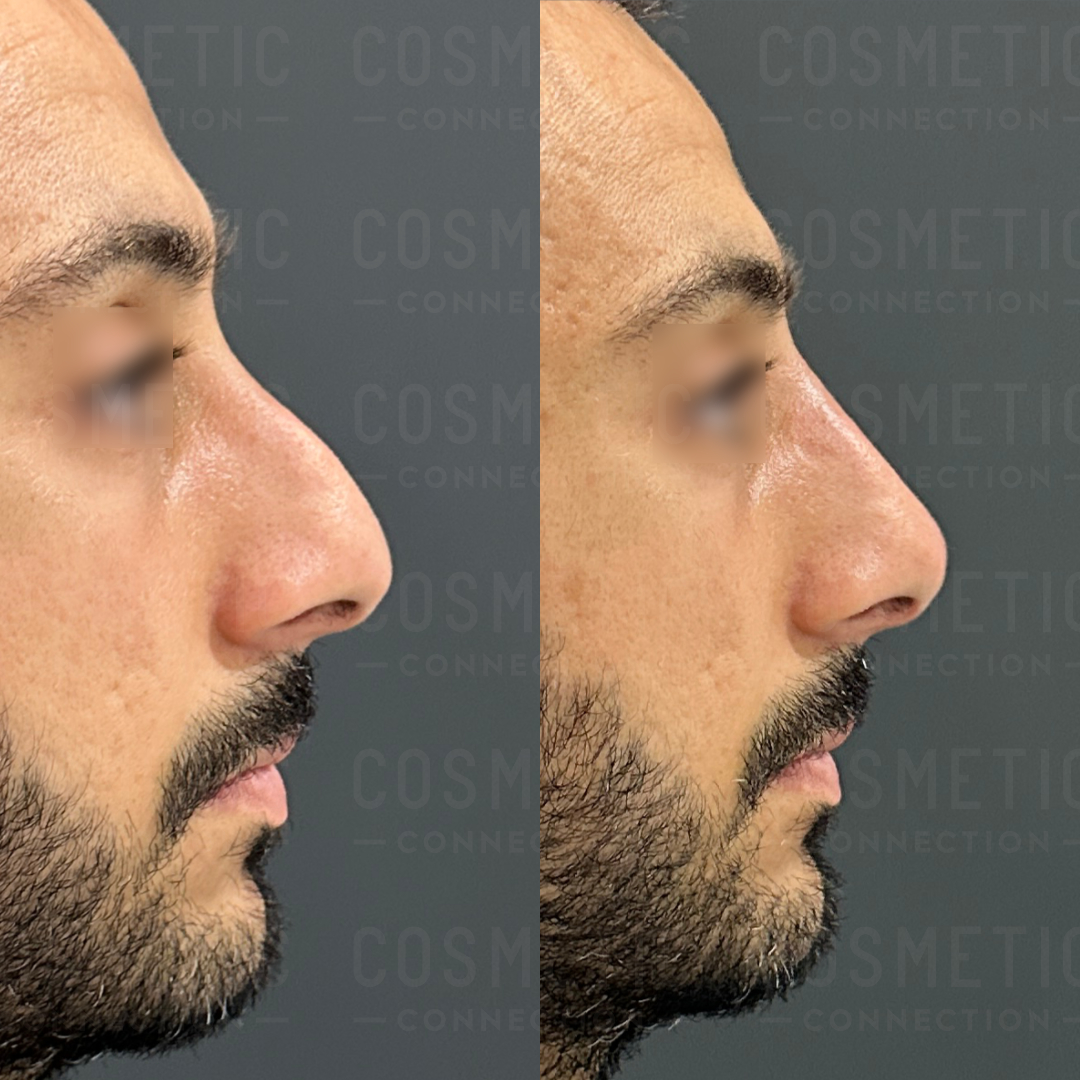 Side-by-side before and after profile images of a person showing changes in the shape of their nose. The left image shows a prominent bridge, while the right image shows a smoother, reduced nasal profile.