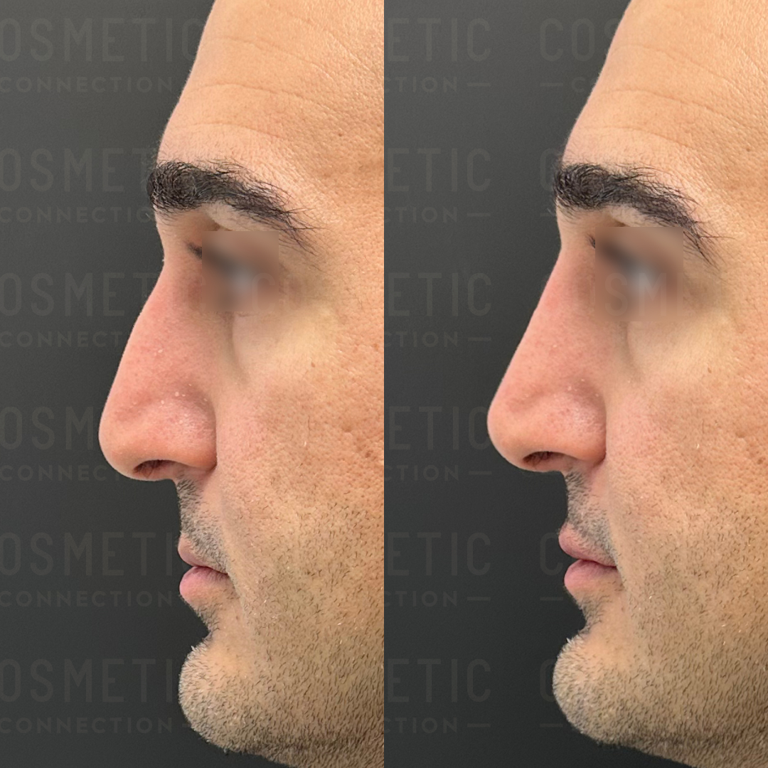 Side-by-side profile images of a mans face showing a before-and-after of cosmetic procedure on his nose. The left image shows a more prominent nasal bridge, while the right image shows a smoother, refined contour.