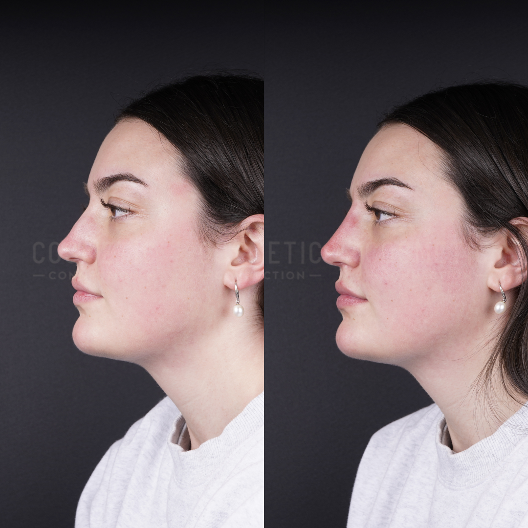 Side-by-side profile photos of a woman with dark hair, before (left) and after (right) a cosmetic procedure. The background is black, and she is wearing a light top and pearl earrings. Her skin shows slight redness.