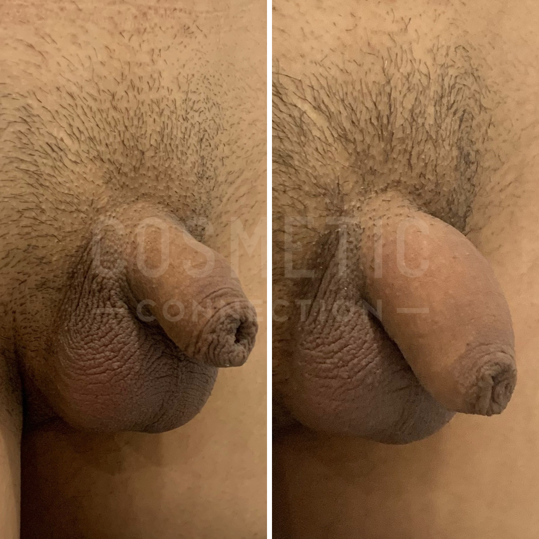 Two side-by-side images showing close-up views of a human nipple and areola area, with visible body hair. Each image depicts a different angle and lighting, highlighting the skin texture and details.