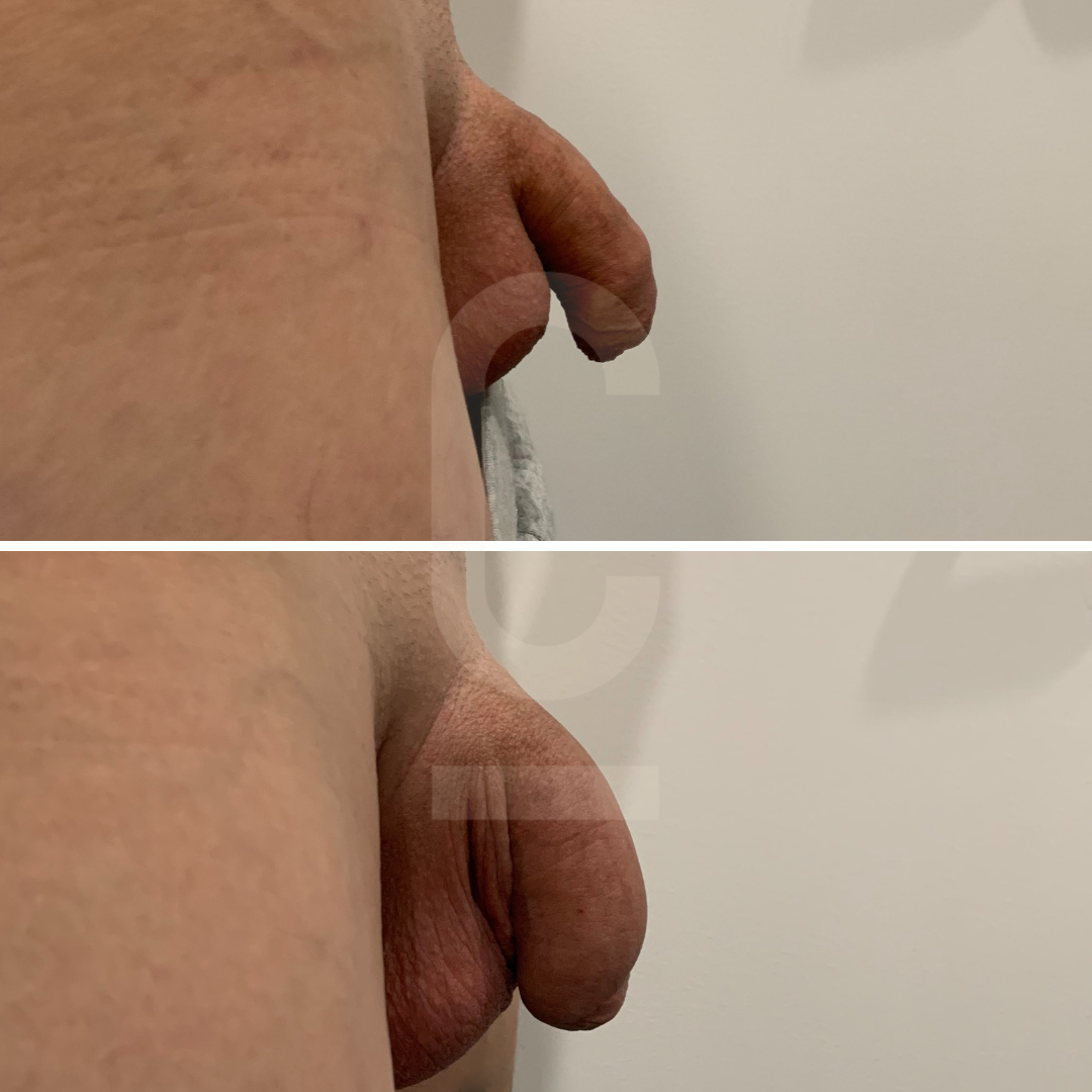 A close-up side view of a persons torso and genital area, with an anatomical change between the top and bottom sections of the image. The lighting is neutral, and the background is plain.