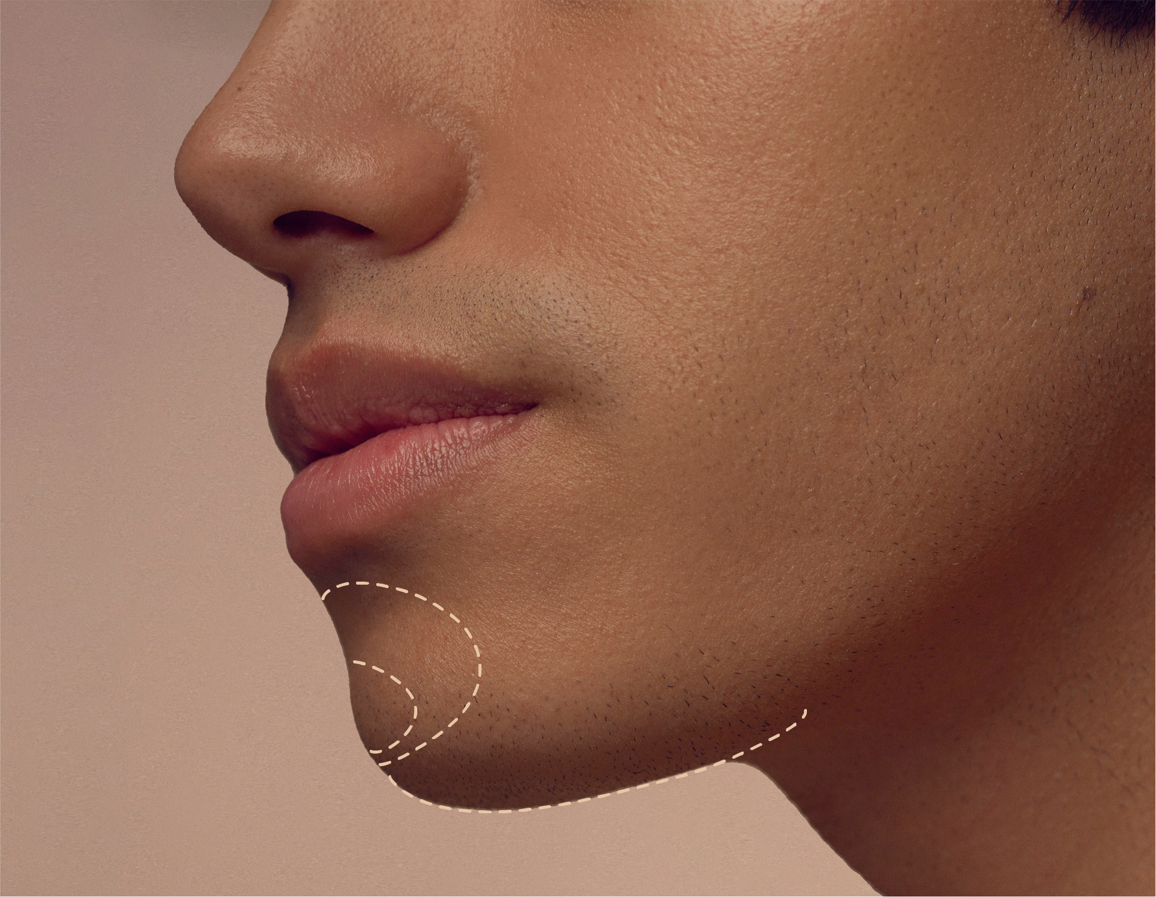 Close-up of a persons profile focusing on the chin, highlighting smooth skin and subtle facial hair. Dashed lines surround the chin area, possibly indicating cosmetic enhancement or facial contouring.