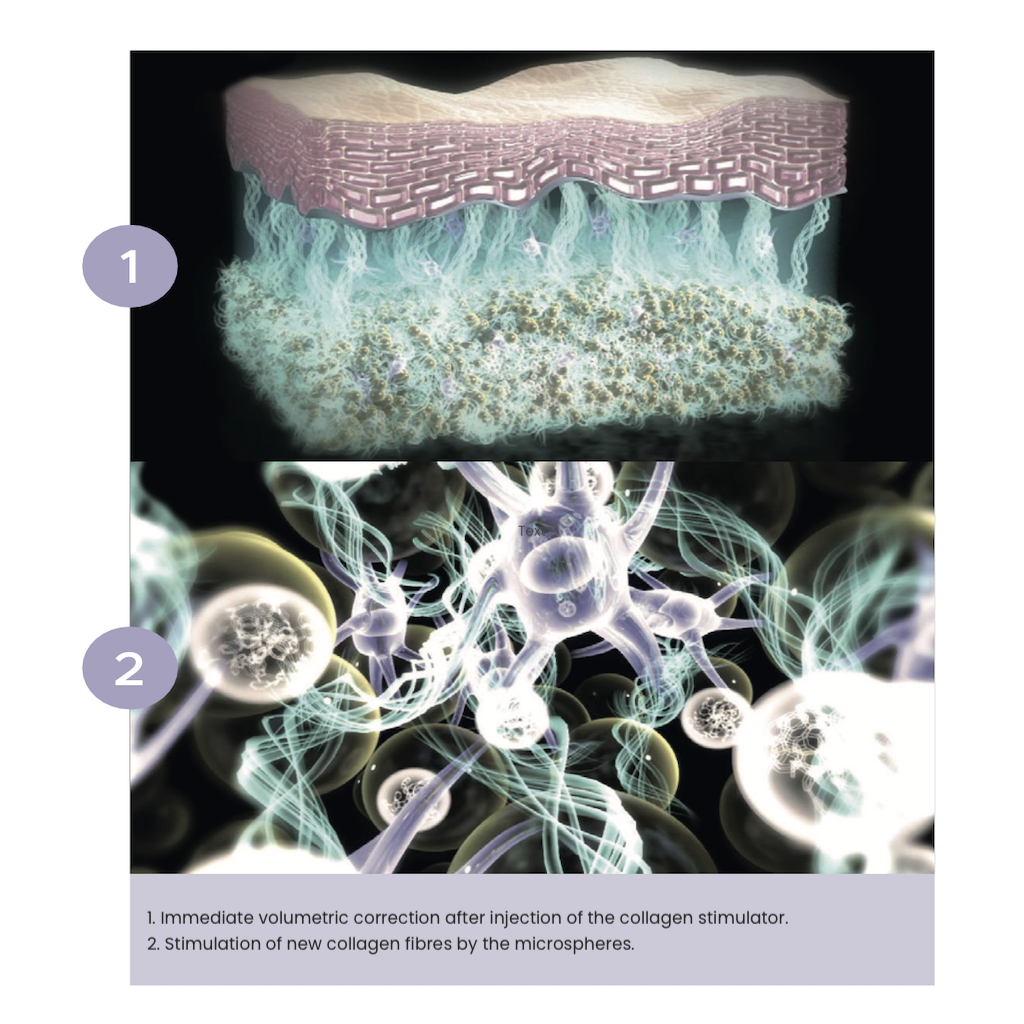 1. Illustration of collagen stimulating injection under skin, showing volumetric correction. 2. Close-up of collagen fibers being stimulated by microspheres, promoting new growth.