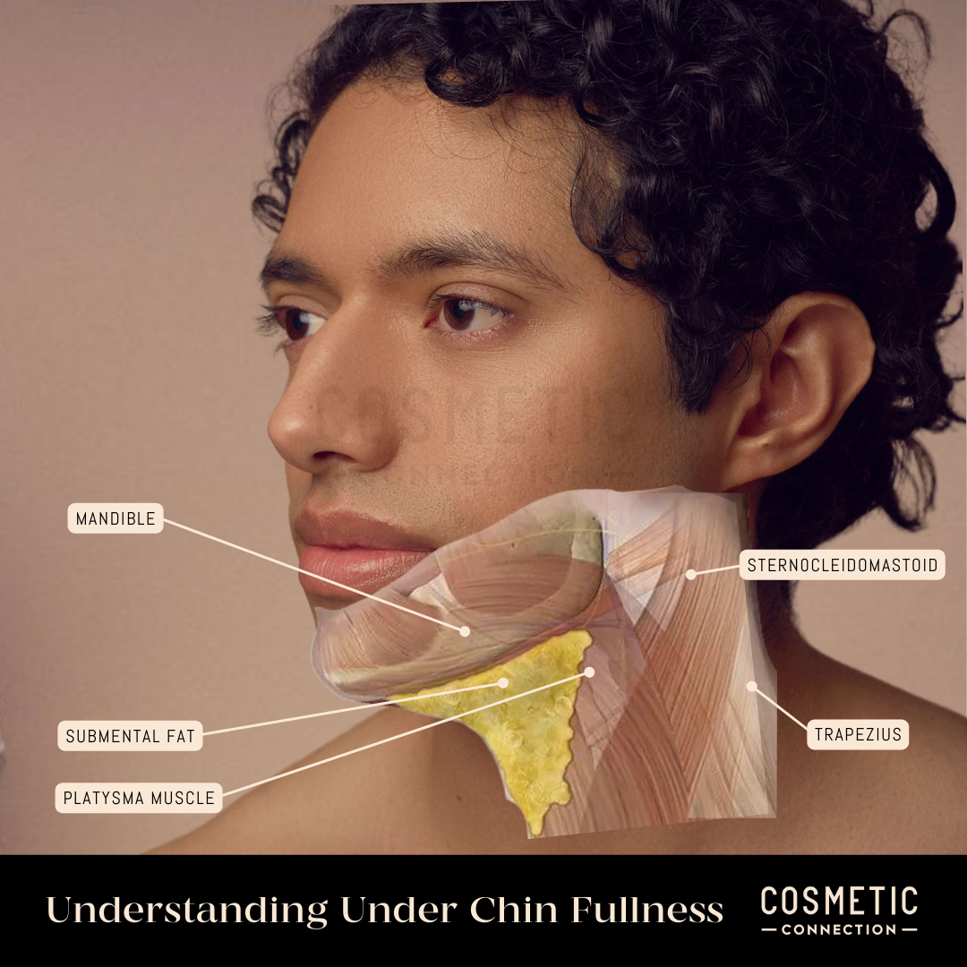 A mans side profile with a transparent overlay highlighting the anatomy under the chin. Labeled features include the mandible, sternocleidomastoid, submental fat, platysma muscle, and trapezius. Text below reads Understanding Under Chin Fullness.