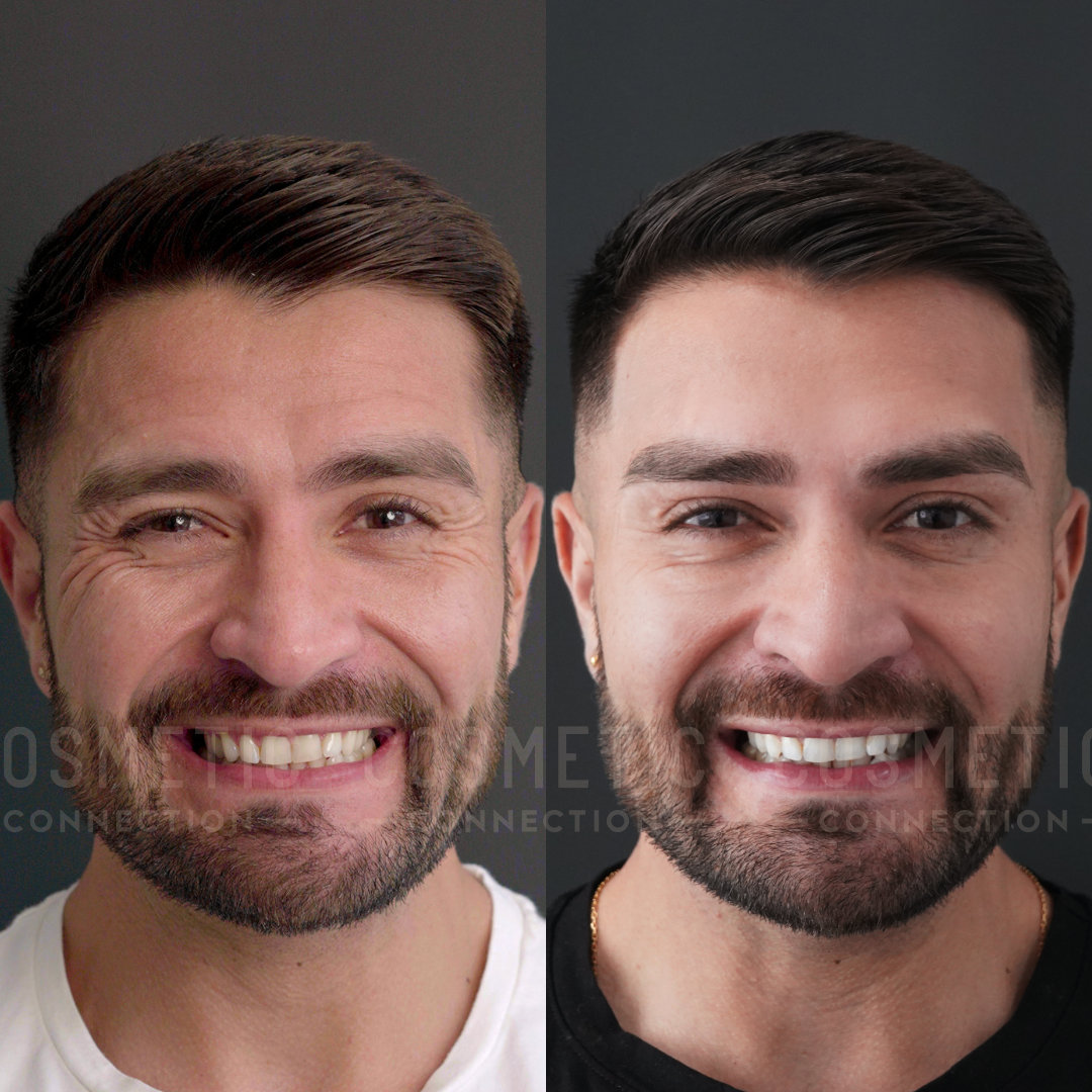Side-by-side photos of a man smiling. The left image shows him with wrinkles and a slightly different hair style. The right image shows a smoother complexion and a more polished hairstyle.