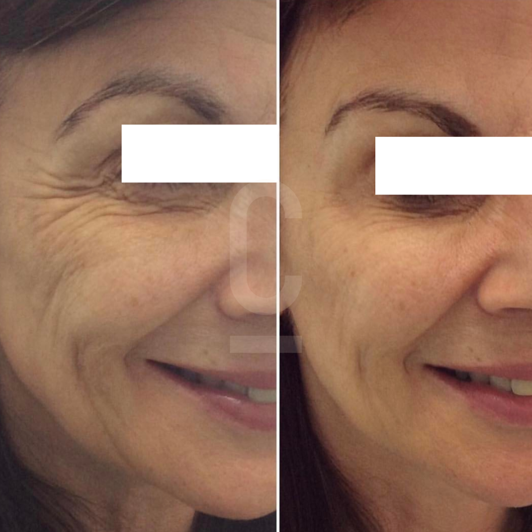 Side-by-side images of a womans face before and after a cosmetic procedure. The left image shows more pronounced wrinkles around the eyes and mouth, while the right image shows smoother skin. Eyes are obscured for privacy.