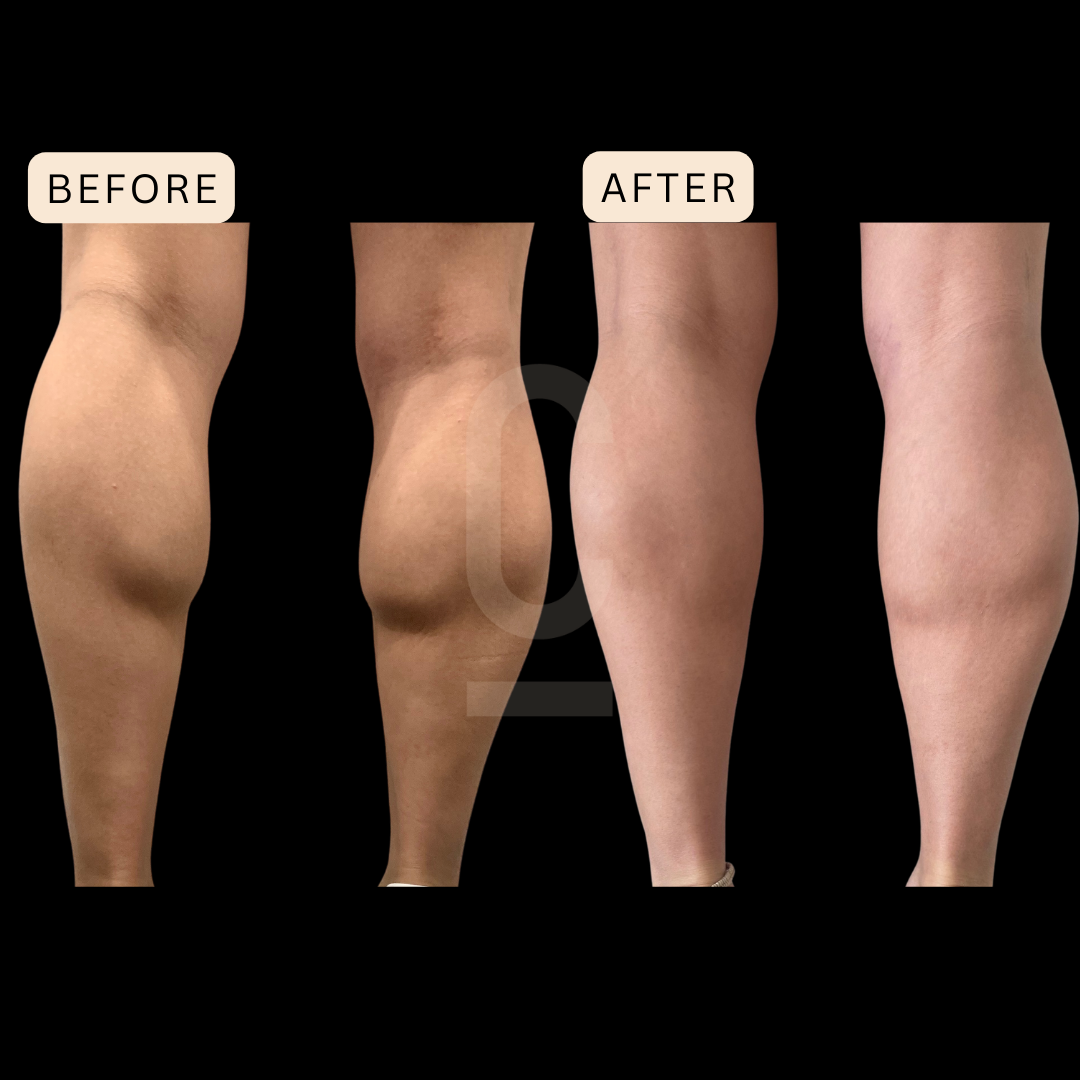 Side-by-side comparison of calves, with Before showing larger calves and After showing slimmer calves, against a black background.