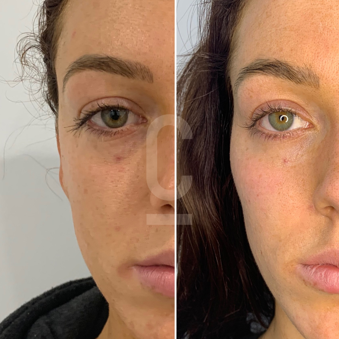 Side-by-side comparison of a womans face showing a before and after skincare treatment. Left side shows skin with slight redness and dark circles; right side appears smoother with reduced redness and under-eye circles.