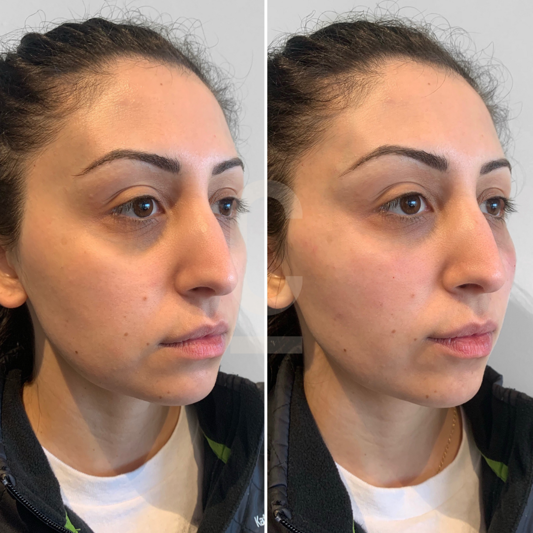 Side-by-side images of a person facing left, showing a comparison before and after a facial treatment. The persons skin appears smoother and more even-toned in the second image. The person is wearing a black jacket over a white shirt.