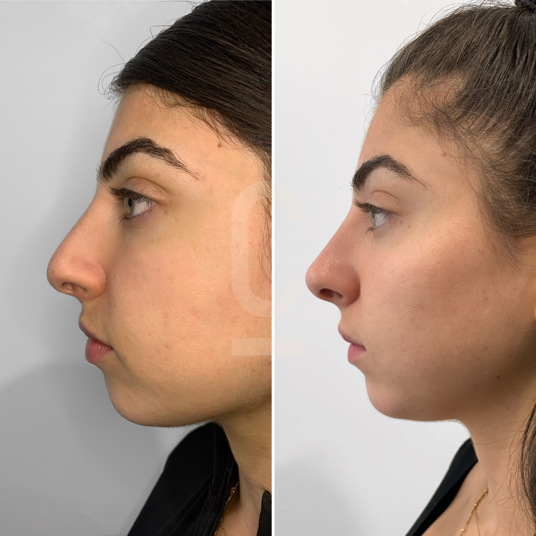 Side-by-side comparison of a persons profile before and after cosmetic surgery. The left image shows a prominent nose and chin, while the right image shows a smoother, more balanced profile. The person has dark hair tied back.