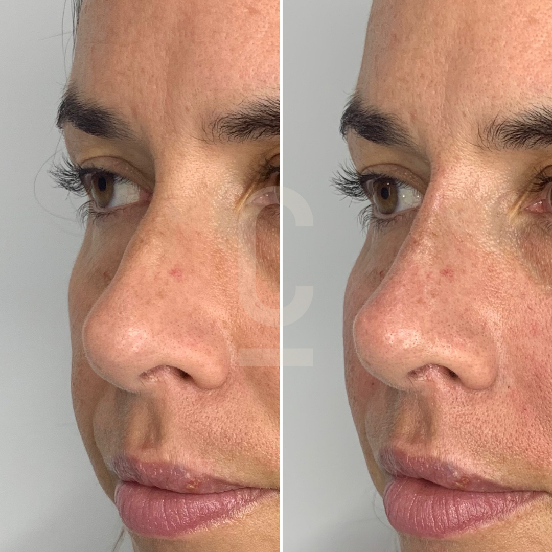 Close-up of a persons face, showing a side-by-side comparison of skin texture. The left image highlights more visible pores and redness, while the right image shows smoother skin and reduced redness.