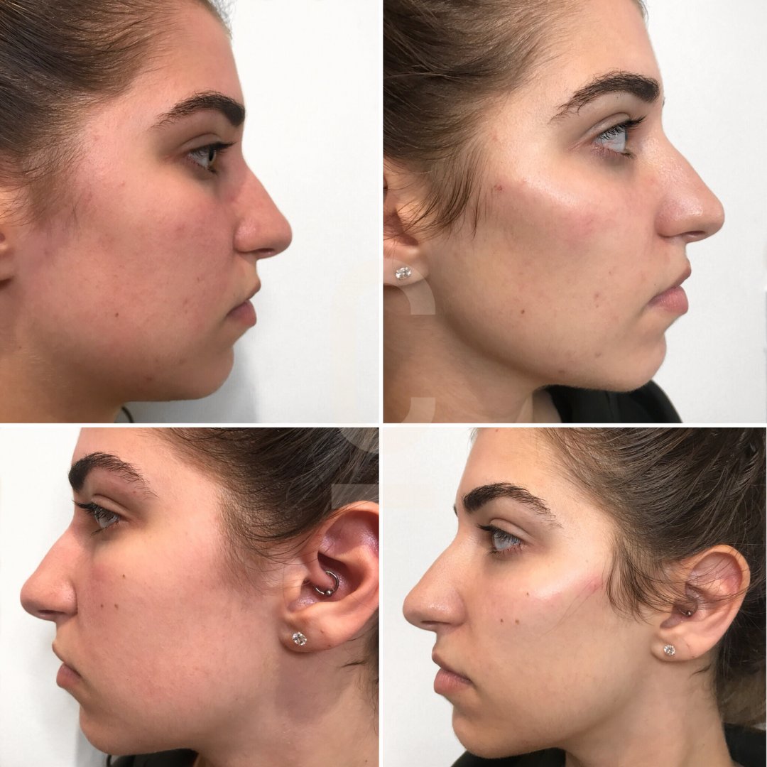 A collage of four side-profile images of a person, showing before and after views of a medical or cosmetic procedure. The top row shows the left and right profiles before treatment, and the bottom row shows the same angles after treatment.