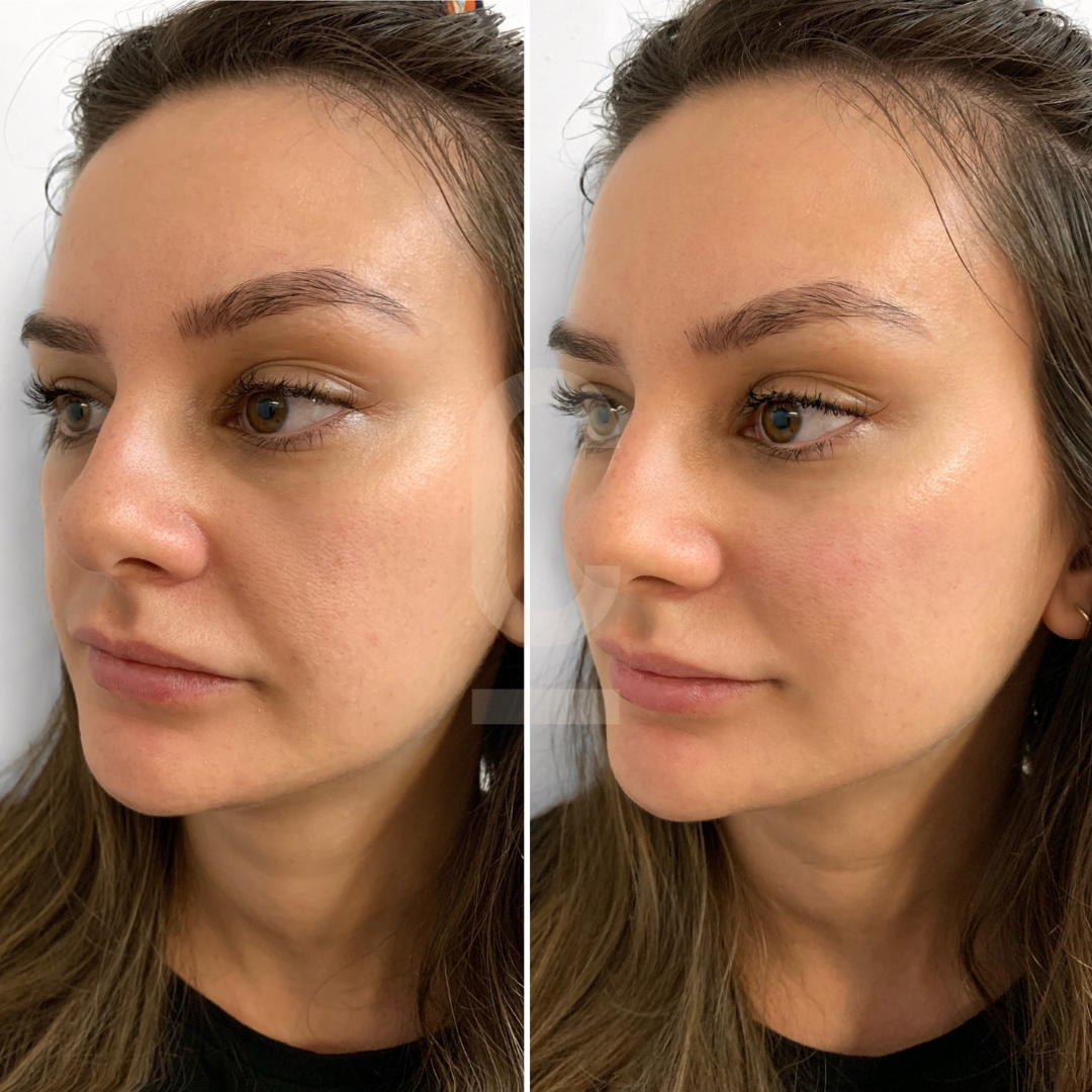 Side-by-side comparison of a womans face before and after a skincare treatment. The left image shows her skin with some visible pores and texture, while the right image displays smoother and clearer skin. She has long brown hair and a neutral expression.