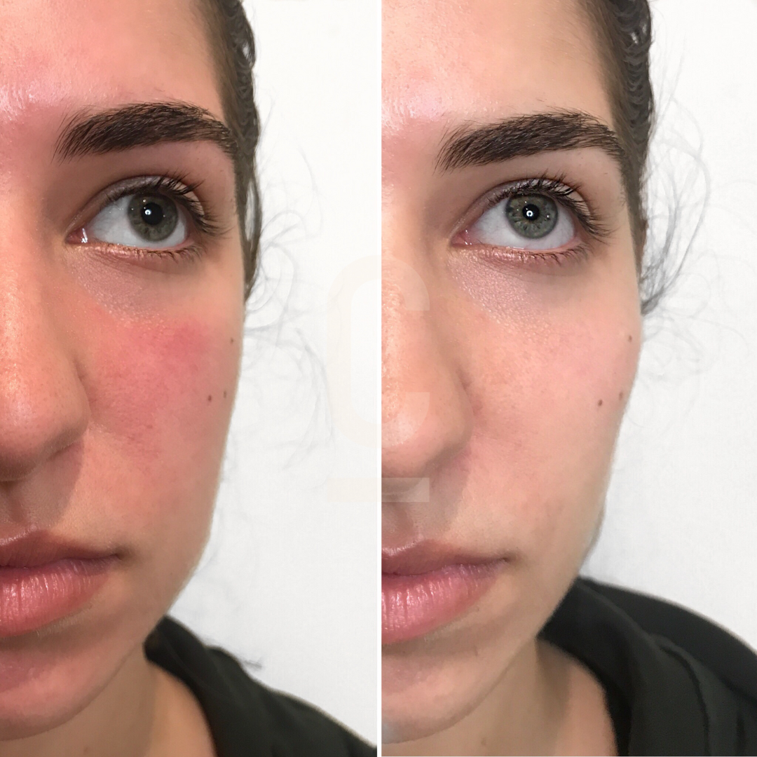 A side-by-side comparison of a persons face, showing the left side with noticeable redness on the cheek and the right side with an even skin tone. The persons eyes are visible, and they have dark hair pulled back.