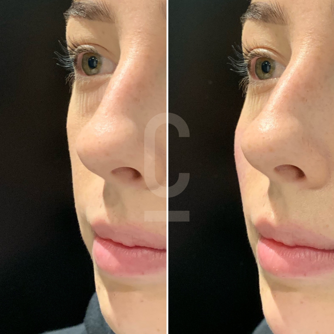 Close-up side-by-side comparison of a persons face before and after a beauty treatment, focusing on the eye and cheek area. The left side shows a more natural look, while the right side appears enhanced, with longer eyelashes.