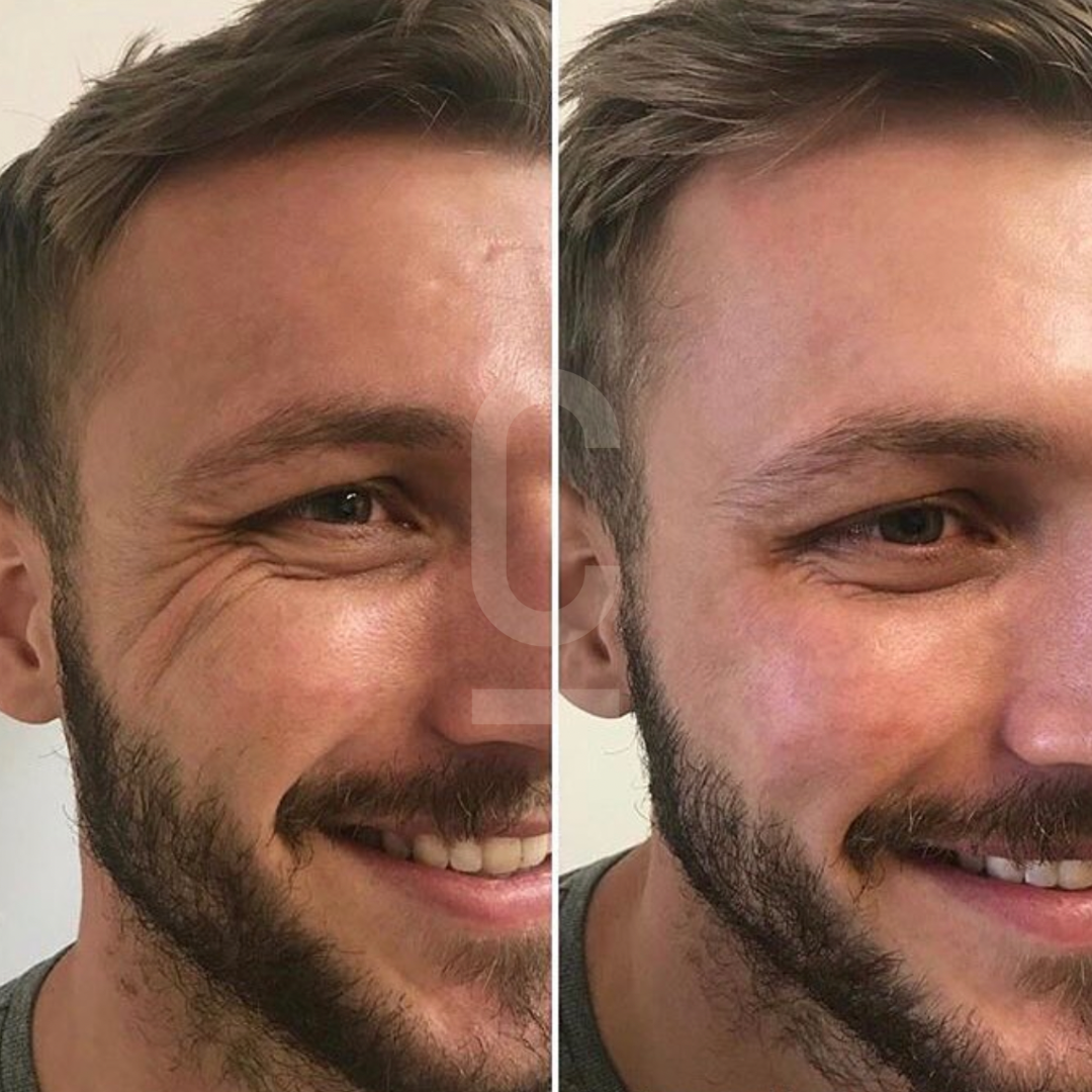 A side-by-side comparison of a bearded mans face. The left side shows the face with prominent under-eye wrinkles, while the right side appears smoother and more youthful. Both images depict the man smiling.