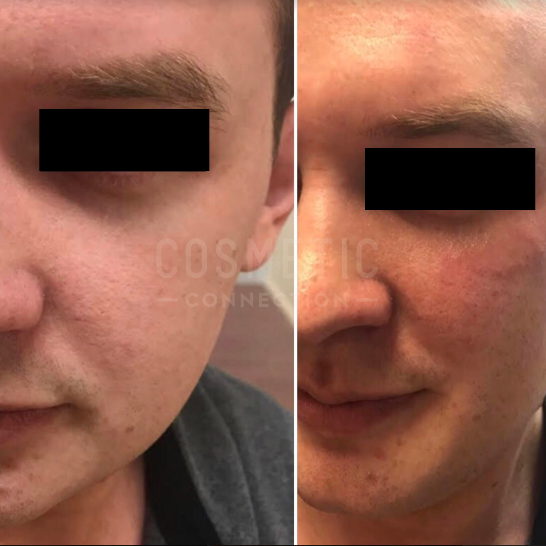 Close-up of a man’s face in two side-by-side photos. The left image shows smoother skin, while the right image displays redness and some texture. The eyes are blacked out for privacy.
