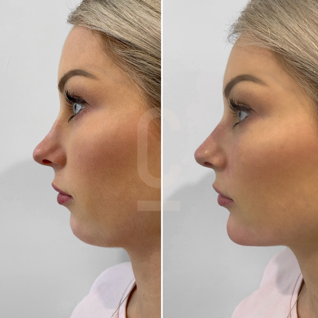 Side-by-side comparison of a womans profile before and after chin augmentation. The left image shows a less defined chin, while the right image shows a more pronounced chin and improved jawline contour.