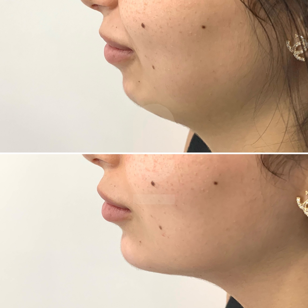 Side-by-side comparison of a womans profile before and after a chin enhancement procedure. The top image shows a less defined chin, while the bottom image displays a more pronounced and contoured chin.