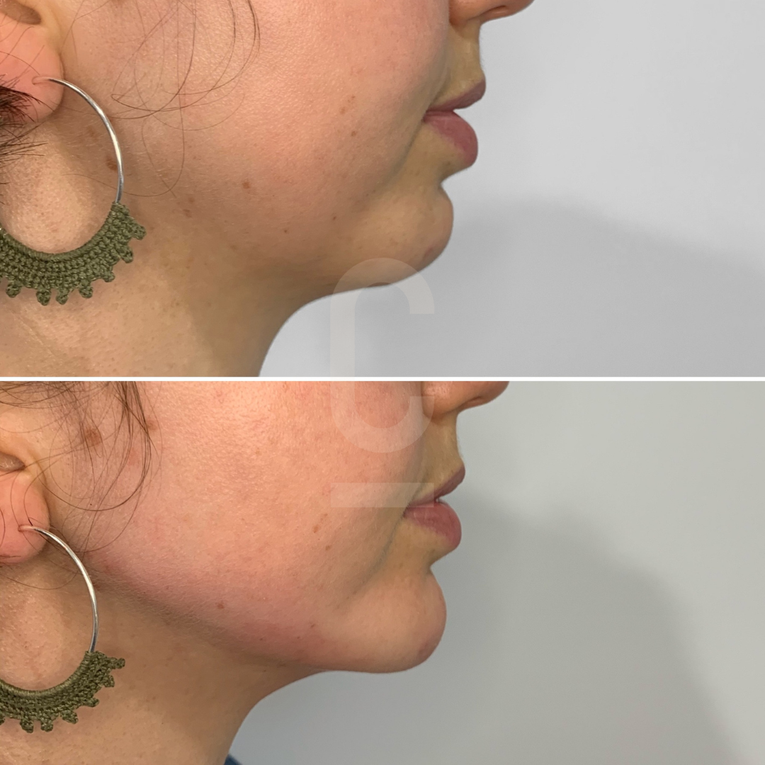 Side-by-side comparison of a persons profile with noticeable improvement in skin firmness under the chin. Both images show the same person wearing large, round earrings. The lower image appears smoother and more contoured.