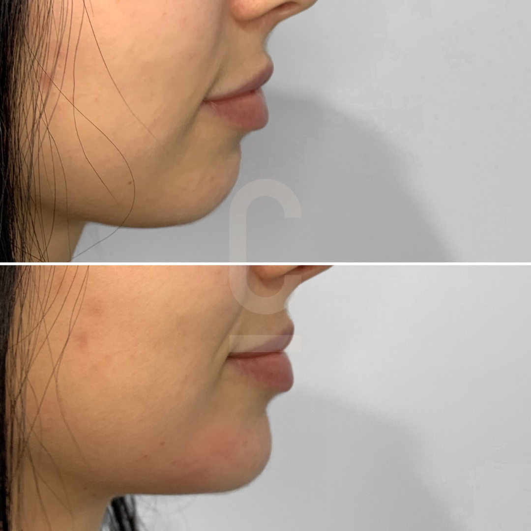 Side-by-side comparison of a womans chin and jawline before (top) and after (bottom) a cosmetic procedure. The bottom image shows a smoother and more contoured profile.