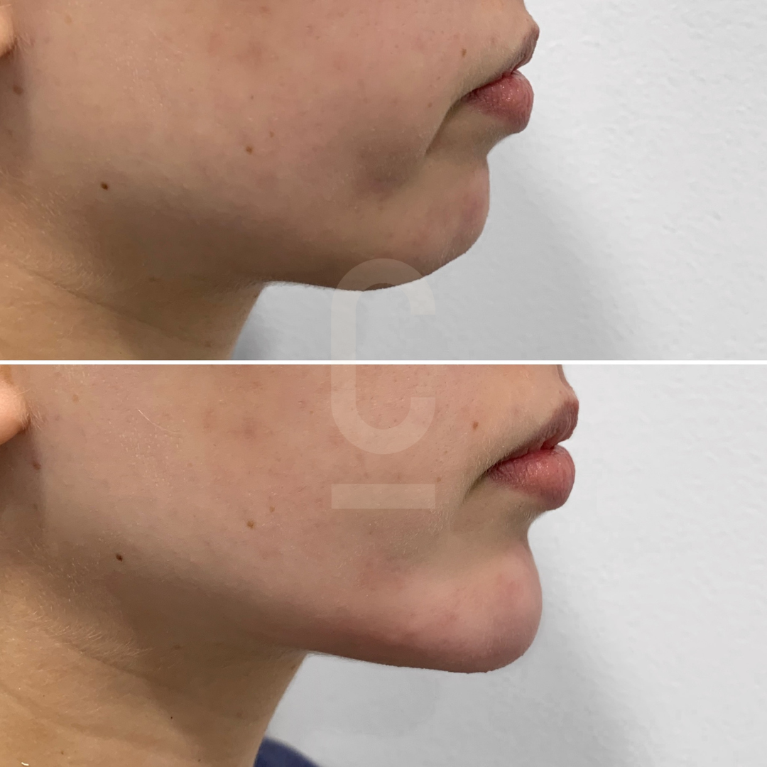 Side-by-side comparison of a persons profile view before and after a cosmetic procedure. The top image shows the initial condition with slight skin irregularities, while the bottom image displays a smoother jawline and improved skin texture.