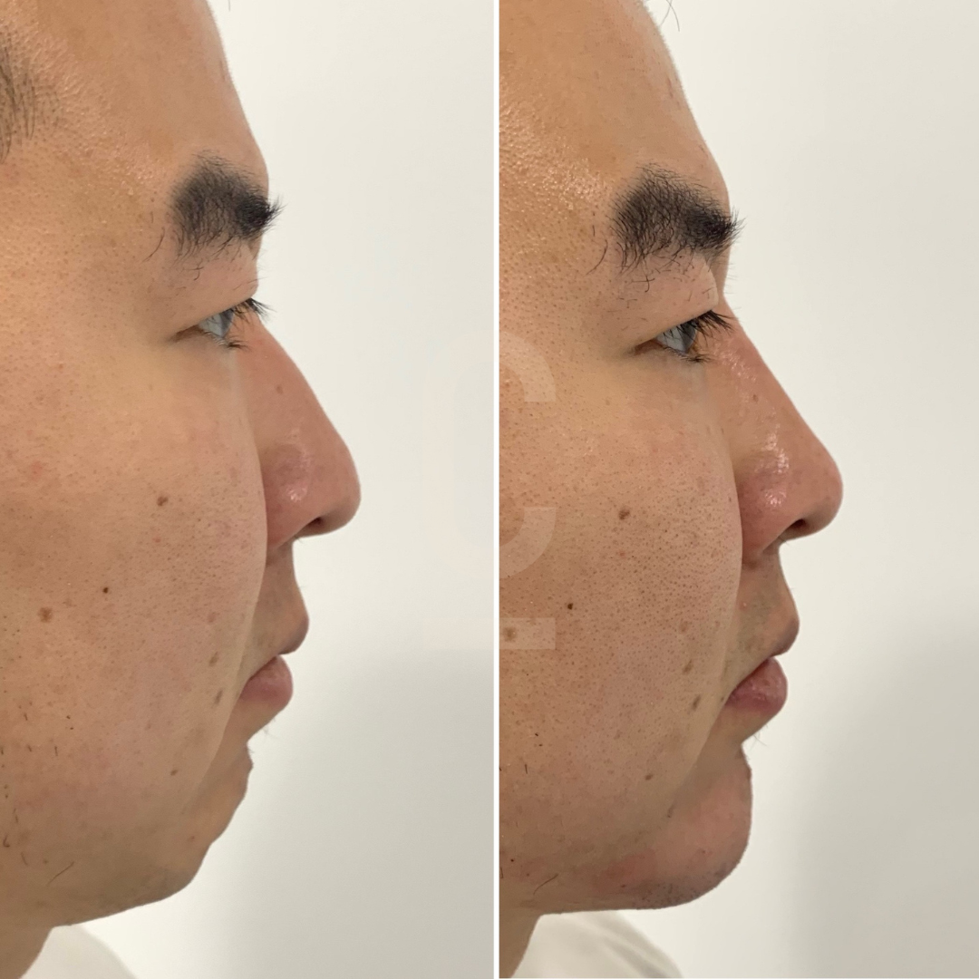 Side-by-side comparison of a mans profile before and after cosmetic treatment. Left image shows a slightly less defined nose and chin, while the right image shows a more refined nose and chin contour. Both images have a neutral background.