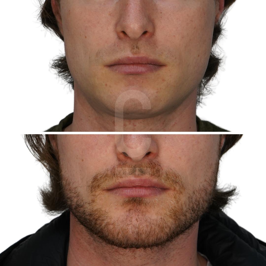 Side-by-side comparison of a persons facial hair transformation. The top half shows a clean-shaven face, while the bottom half shows the same face with a short beard. The person has light skin and wears a dark jacket.