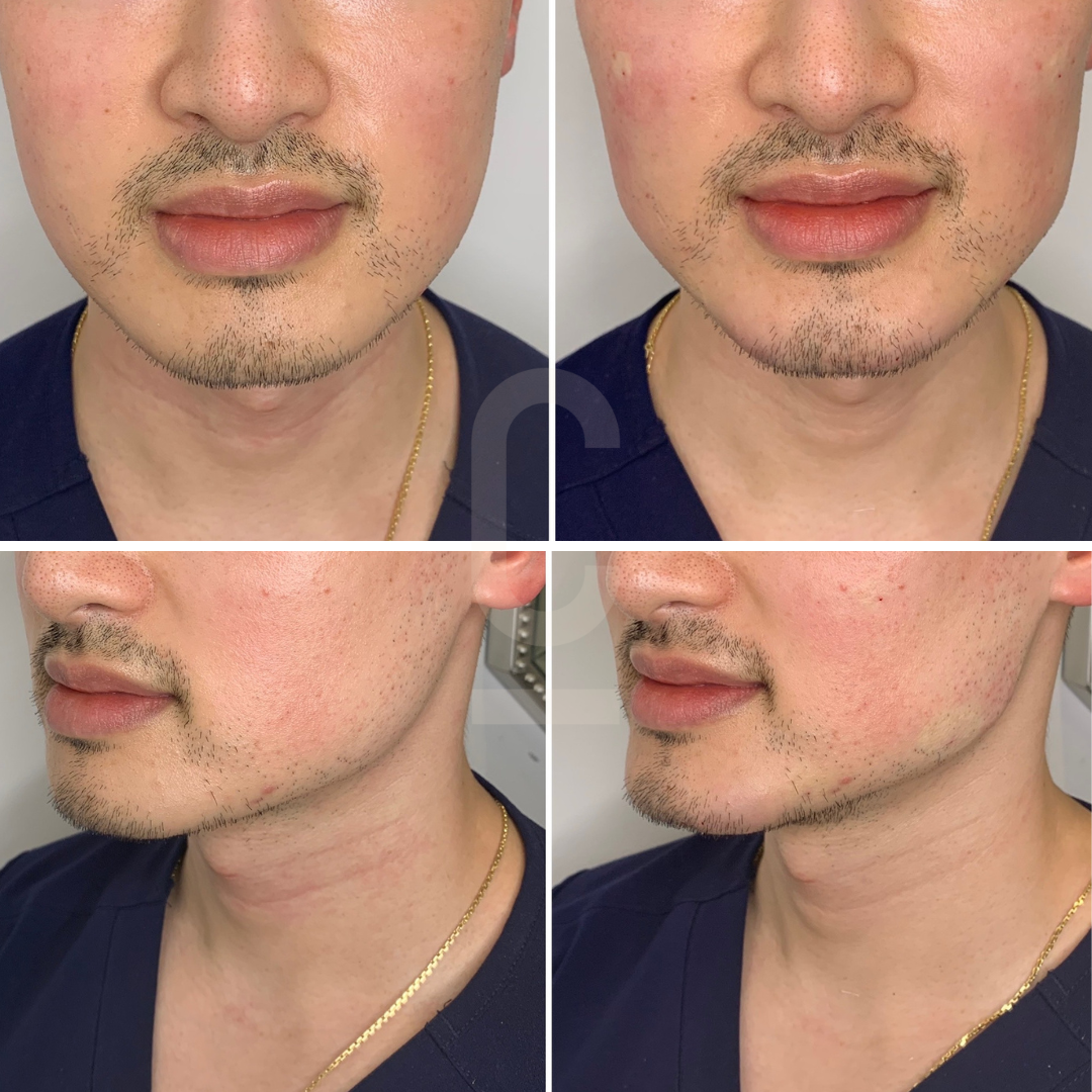 Four images of a person with facial hair, focusing on the lower face and neck area from different angles. The person is wearing a dark top and a gold chain necklace. The skin appears slightly red in some areas.