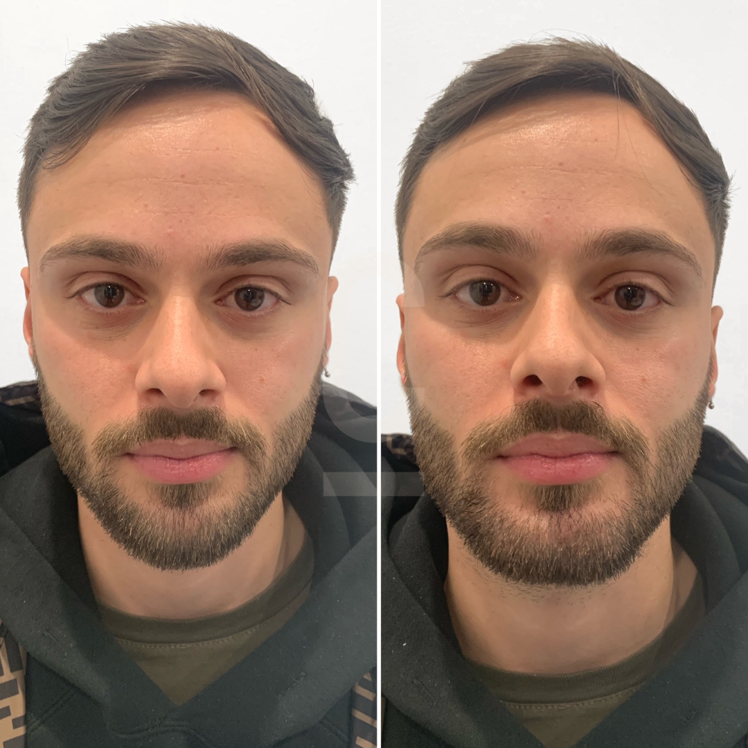 Two side-by-side images show a man with short hair and a beard, wearing a dark hoodie with a patterned strap. The left image has softer lighting compared to the right. The background is plain white.