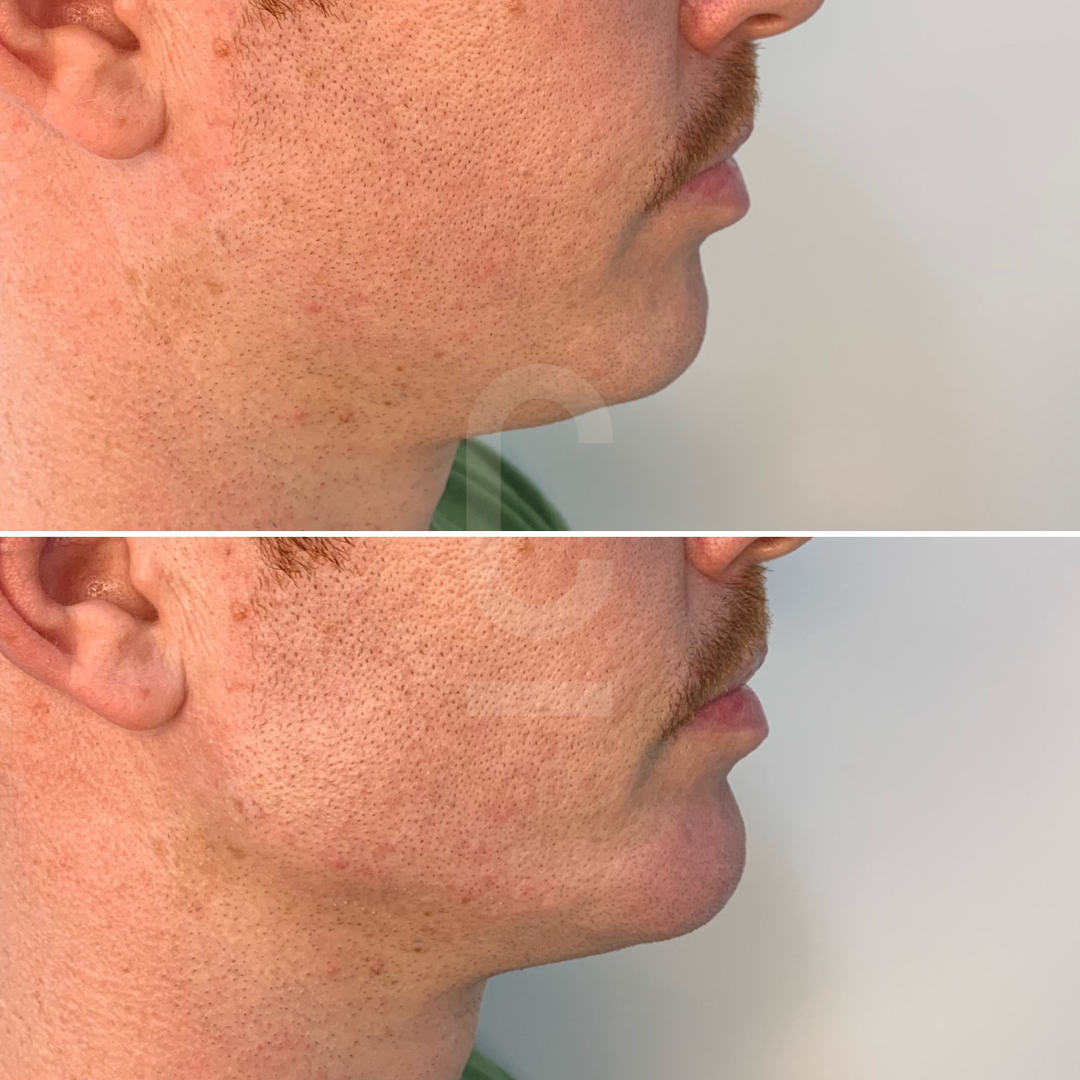 Side-by-side comparison of a persons face showing the neck and jawline before and after a treatment. The top image shows a softer jawline, while the bottom image shows a more defined jawline and reduced chin area.