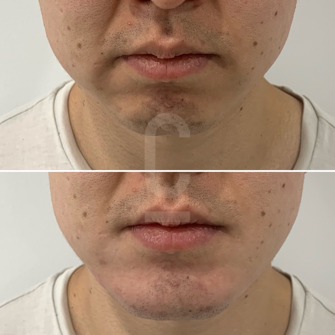 A split image showing a close-up of a persons lower face before and after treatment. The top image shows slight stubble, while the bottom image shows a smoother chin and jawline with less visible stubble.