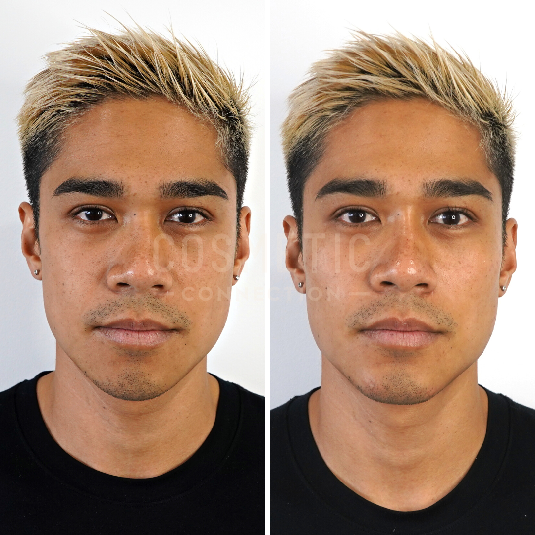 A side-by-side comparison of a person with short, dyed blond hair. The left image shows them before cosmetic changes, and the right image shows them after. Both images have a neutral expression and are set against a plain background.