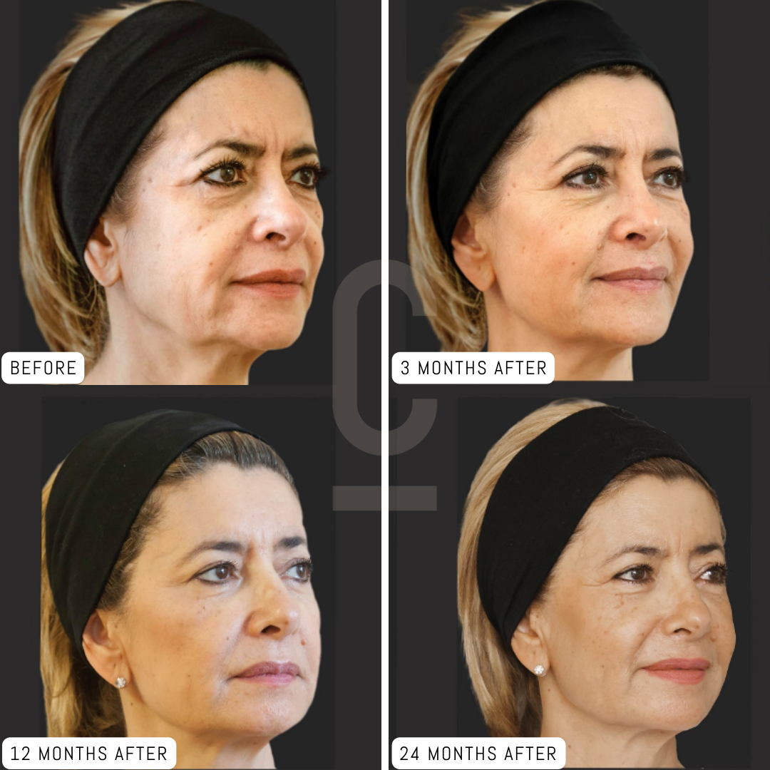 Four side-by-side images showing a woman wearing a black headband. Top left: labeled Before, visible signs of aging. Top right: 3 Months After, improved skin. Bottom left: 12 Months After, smoother appearance. Bottom right: 24 Months After, youthful look.