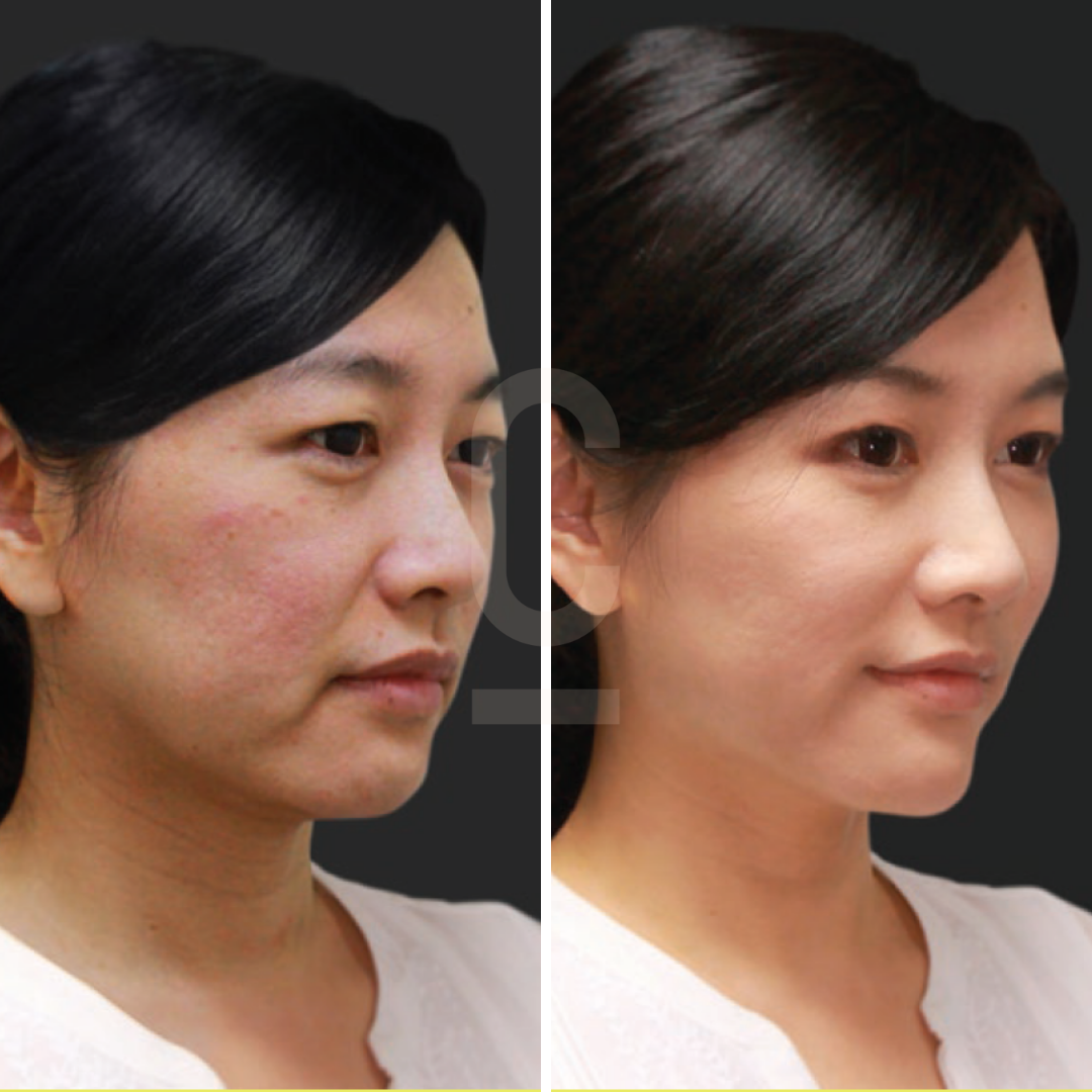 Side-by-side comparison of a womans face showing before and after images. The left image shows her with redness on her skin, while the right image displays a clearer, smoother complexion. She has dark hair and is wearing a white top.