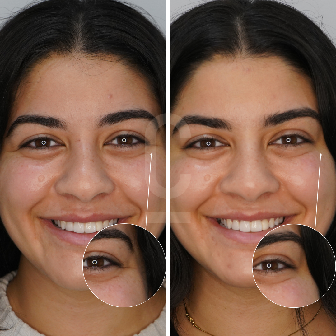 Side-by-side comparison of a woman before and after skincare treatment. The left image shows her skin with mild imperfections, and the right image shows smoother, clearer skin. Insets magnify her eye area to highlight improvement.