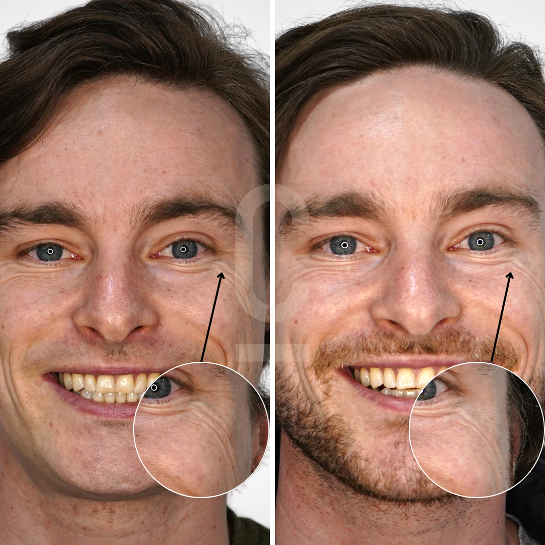 A side-by-side comparison of a man smiling with white teeth and blue eyes. The left image shows him clean-shaven; the right shows him with a beard. Arrows and magnified circles highlight differences around the eyes.