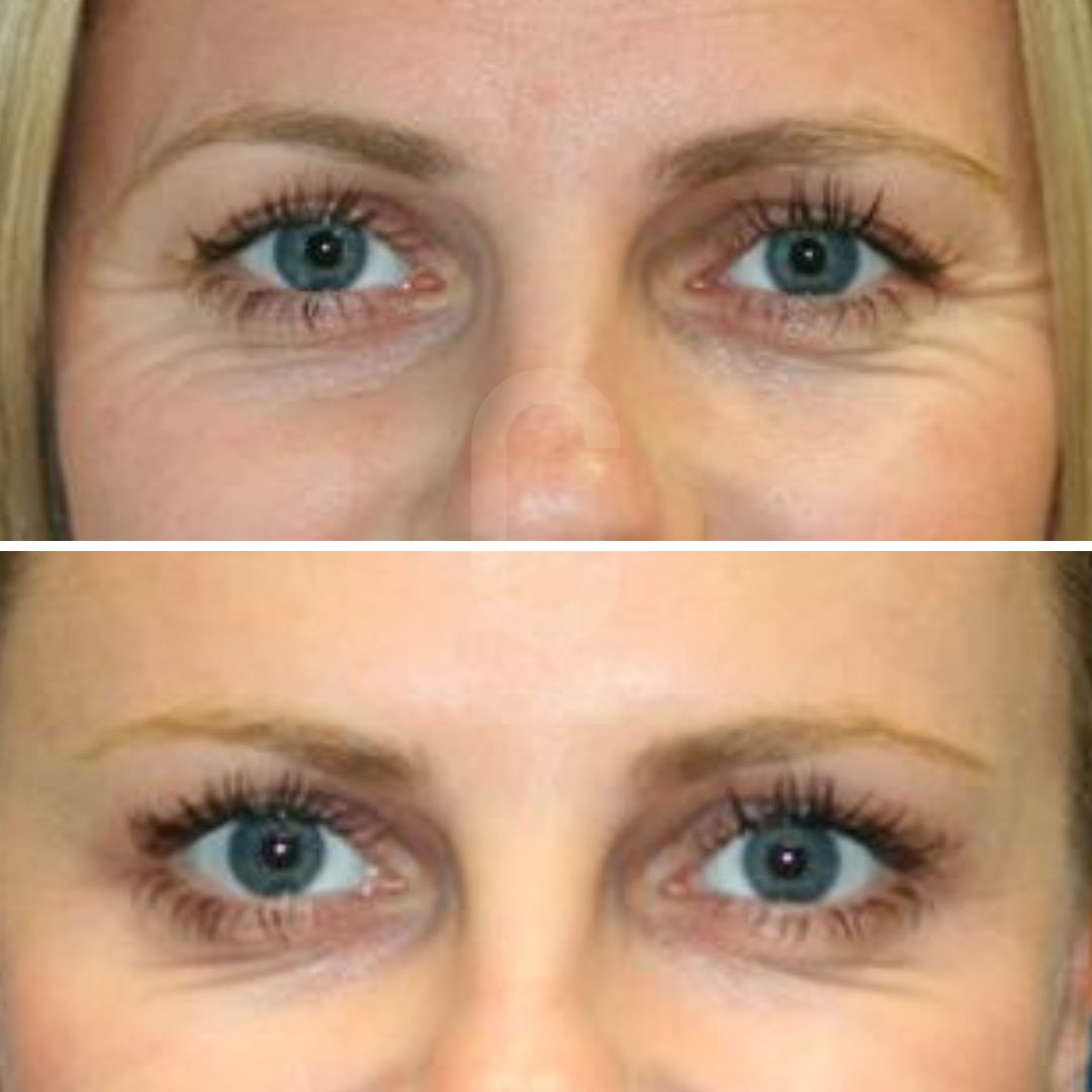 Close-up of a persons eyes, shown in two images. The top image shows visible wrinkles around the eyes. The bottom image shows the same eyes with smoother skin and reduced wrinkles, likely indicating an effect of cosmetic treatment.
