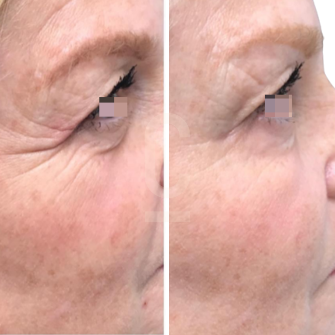 Side-by-side comparison showing a close-up of a persons eye area before and after a cosmetic treatment, highlighting reduced wrinkles and smoother skin in the after image.