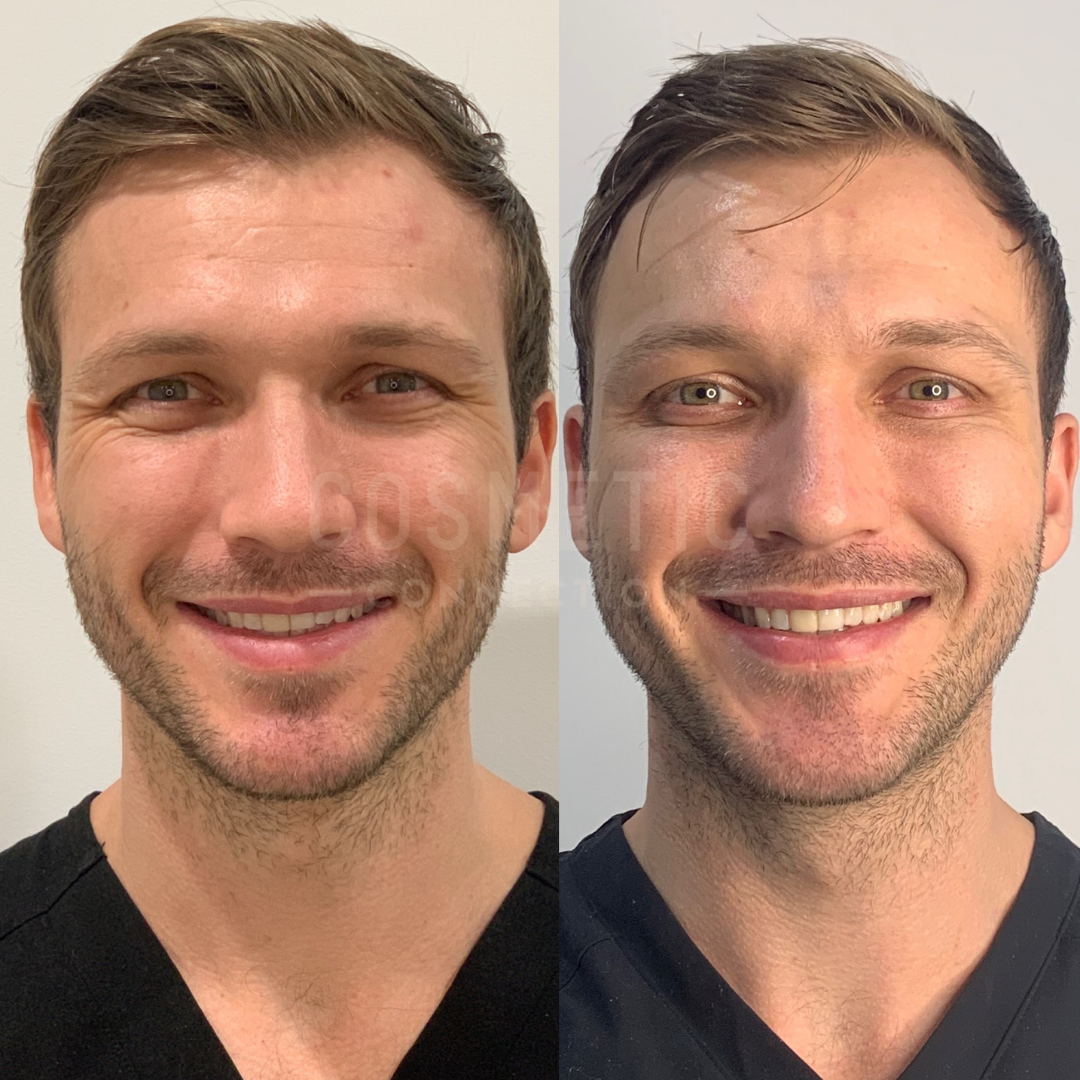 Split image of a man with short hair and facial stubble, wearing a black shirt. Left: slight redness on the forehead. Right: clearer skin tone. Both images show him smiling against a plain background.