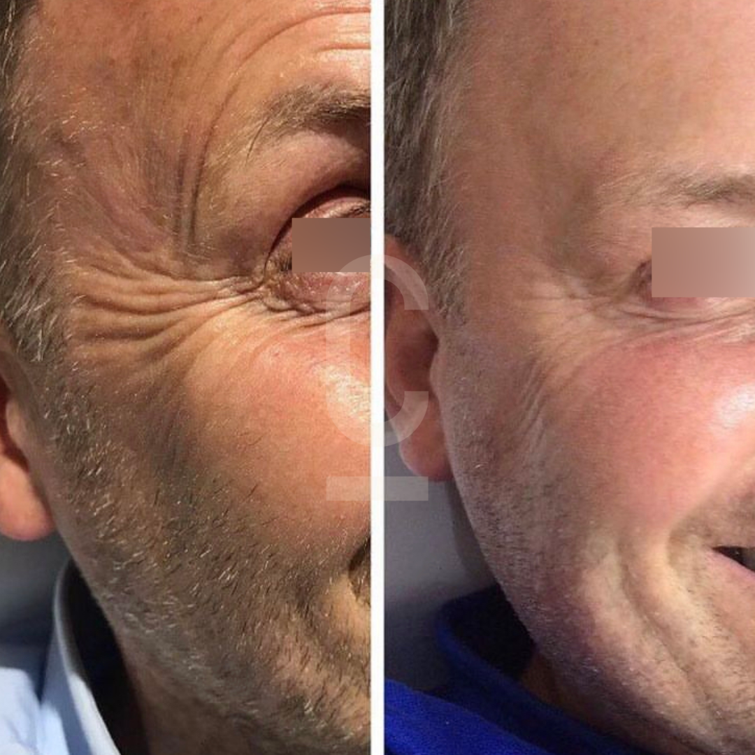 Split image comparing the same mans eye area before and after treatment. The left side shows more pronounced wrinkles, while the right side displays smoother skin, indicating reduction in wrinkles. Eyes are obscured for privacy.