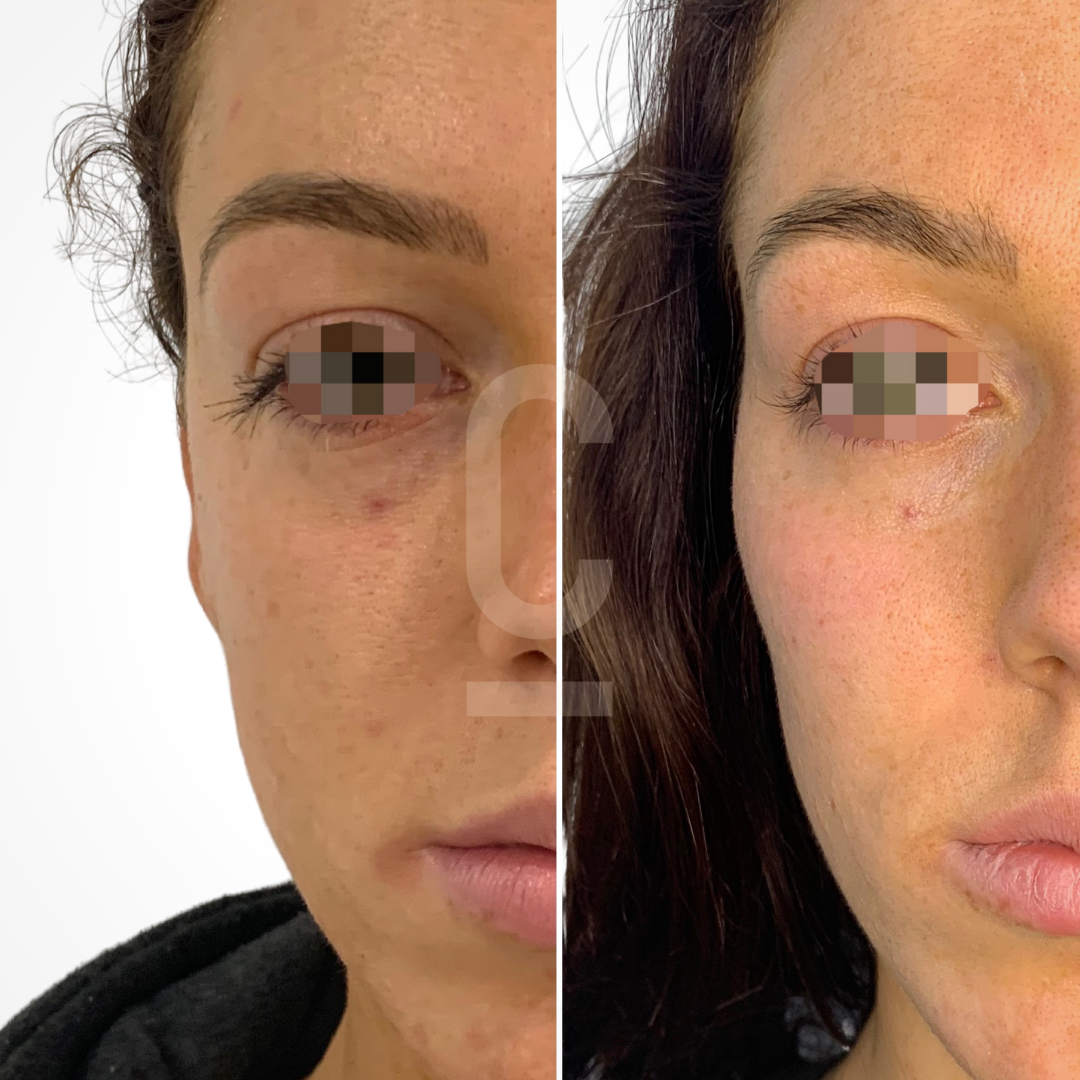 Close-up of a womans face split into two side-by-side images. Both show her complexion in detail with minor blemishes visible. Her eyes are pixelated for privacy. She has long brown hair and is wearing a black top.