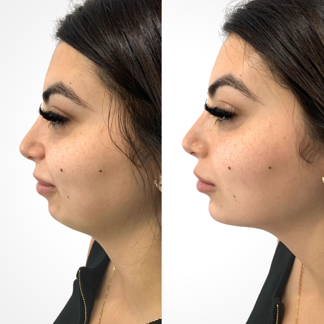 Side-by-side comparison of a persons profile before and after a cosmetic procedure. The left image shows a fuller chin and neckline, while the right image shows a more defined chin and streamlined profile.