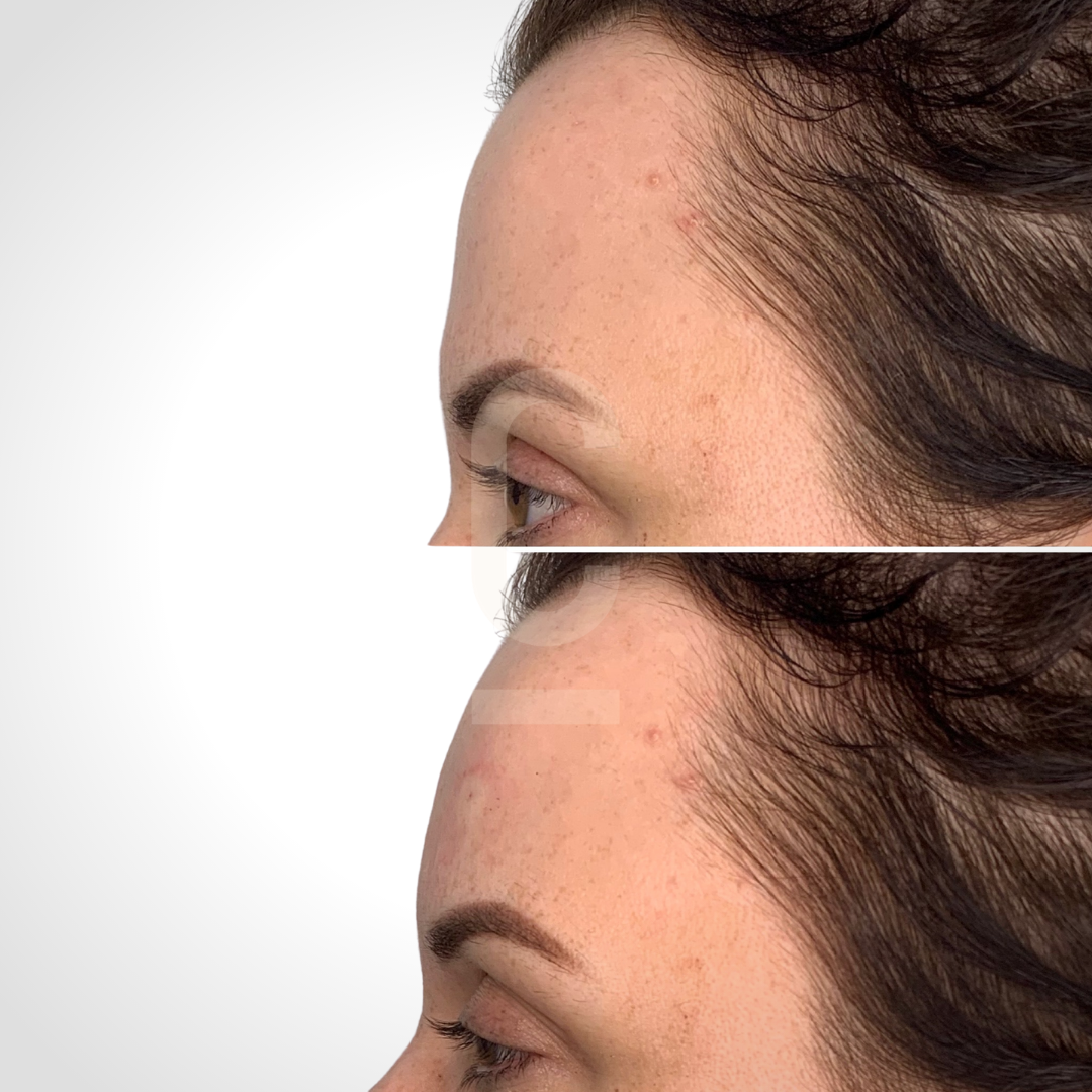 Side-by-side comparison of a persons forehead before and after Botox treatment. The top image shows wrinkles, while the bottom image displays smoother skin. Hair is dark and wavy. The focus is on the facial area above the eyebrows.