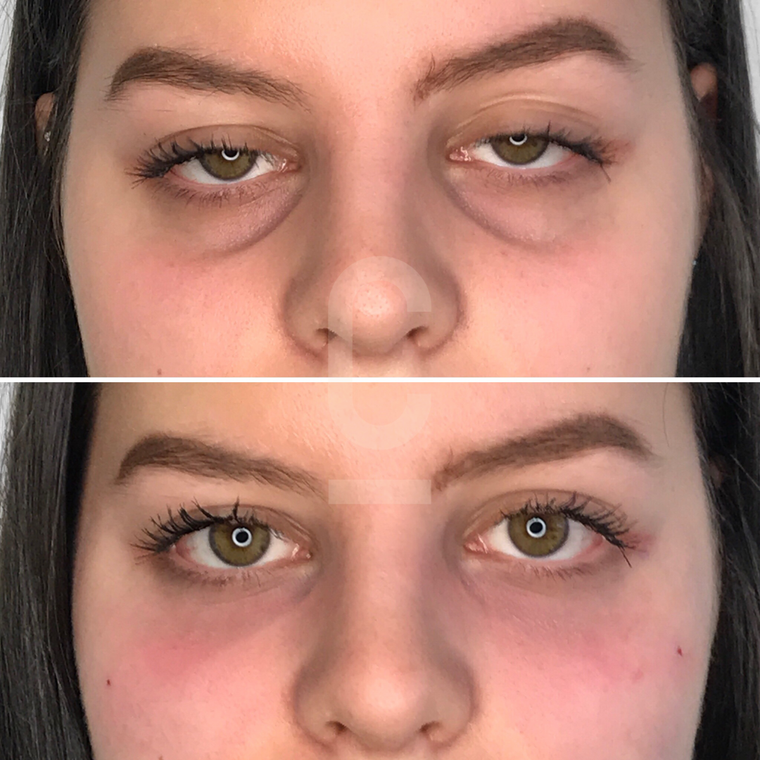 Close-up of a persons face showing a before and after comparison. The top image displays the person with noticeable under-eye circles and swelling, while the bottom image shows a reduction in dark circles and swelling.