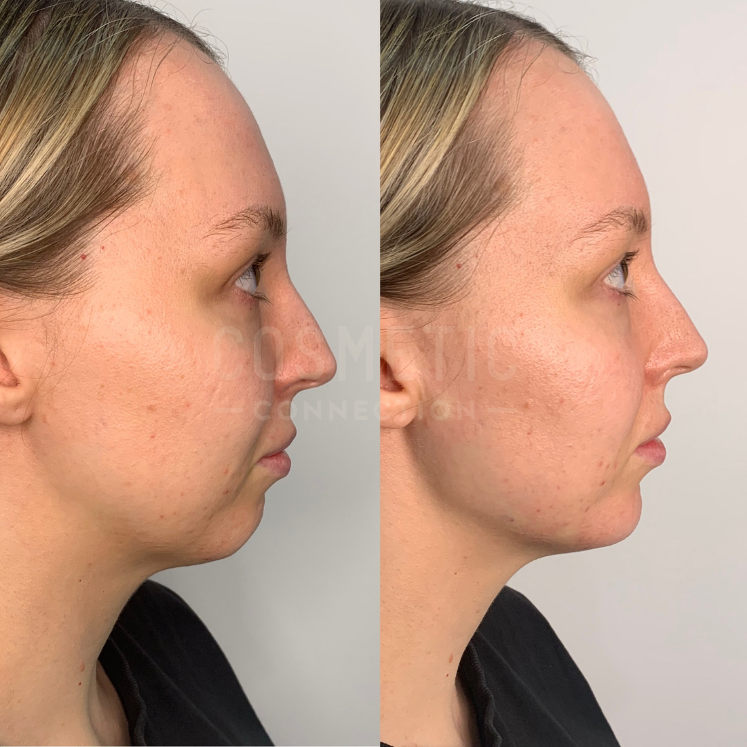 Side-by-side profile comparison of a woman before and after a cosmetic procedure. The left image shows a slightly recessed chin and fuller neck. The right image displays a more defined chin and smoother neck contour.